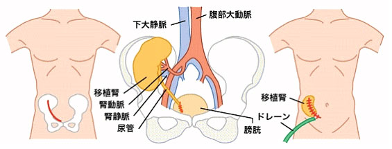腎移植の手術図